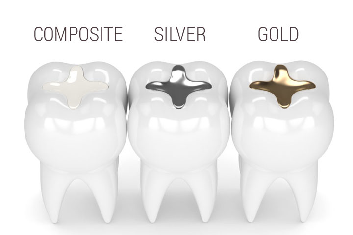 dental-fillings-gold-silver-composite