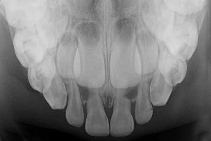 Anterior Occlusal X-ray