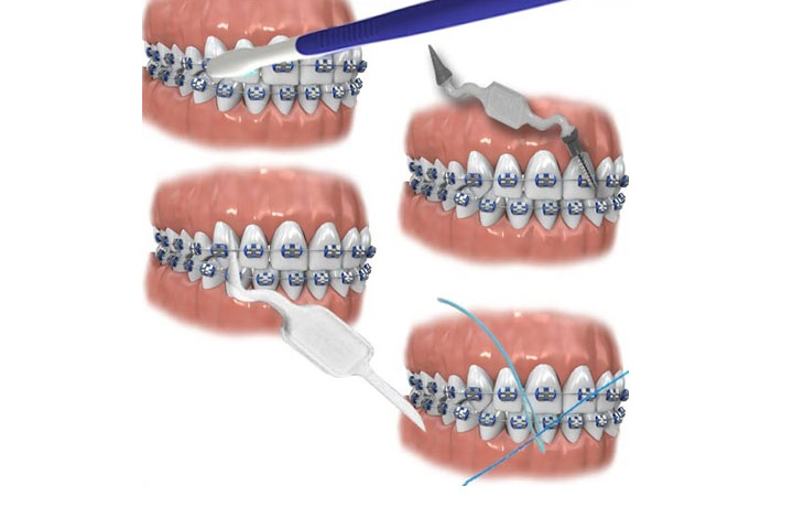 cleaning-dental-braces-2