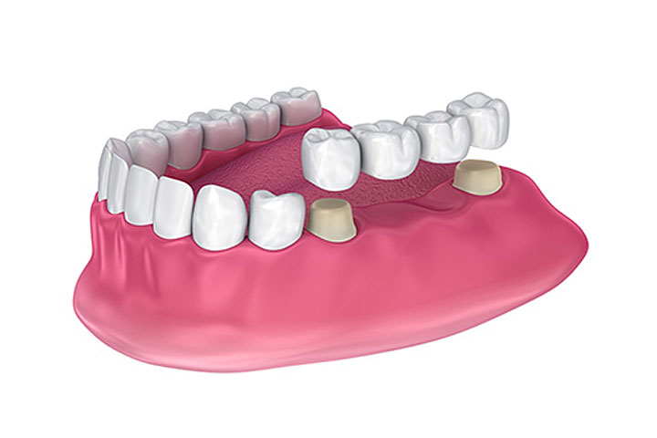 dental-crowns-bridges-dentist-mira-road