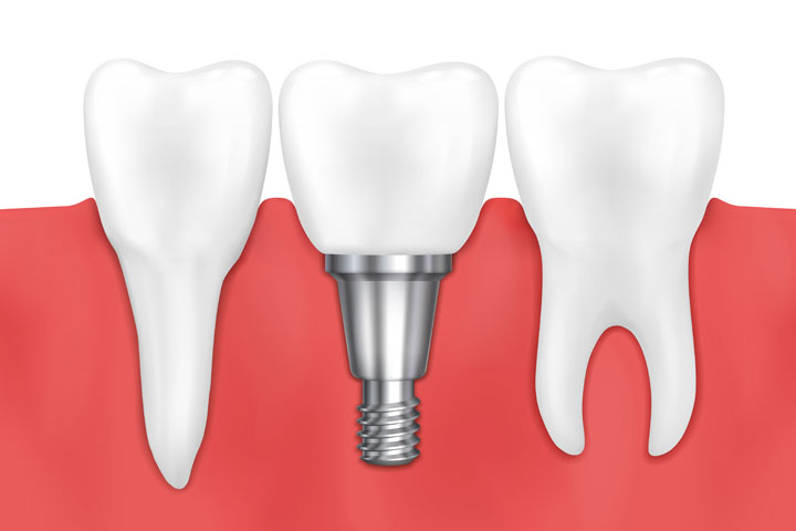 dental-implants-dentists-in-mira-road