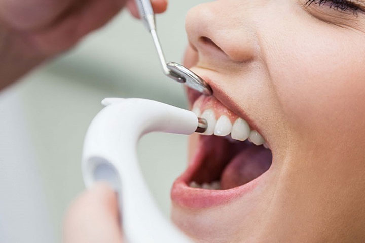 dental-scaling-polishing