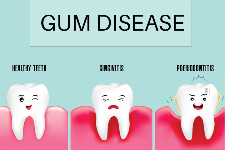 gum-disease-diagram