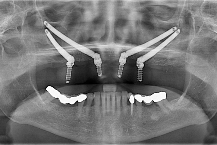 jaw-x-ray-dental-implants