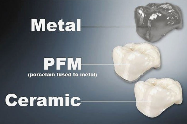 metal-ceramic-porcelain-tooth-crowns