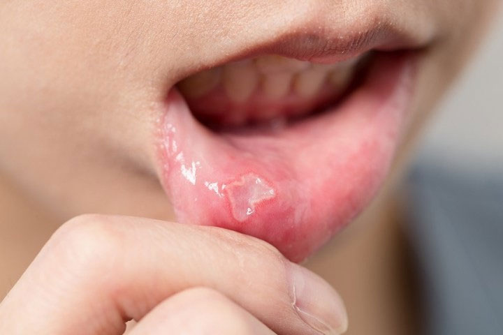 mouth-ulcers-causes-symptoms-treatment