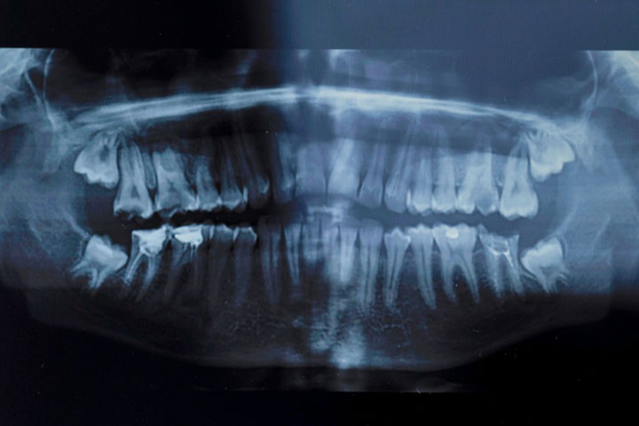 panaromic-x-rays-dental-cure