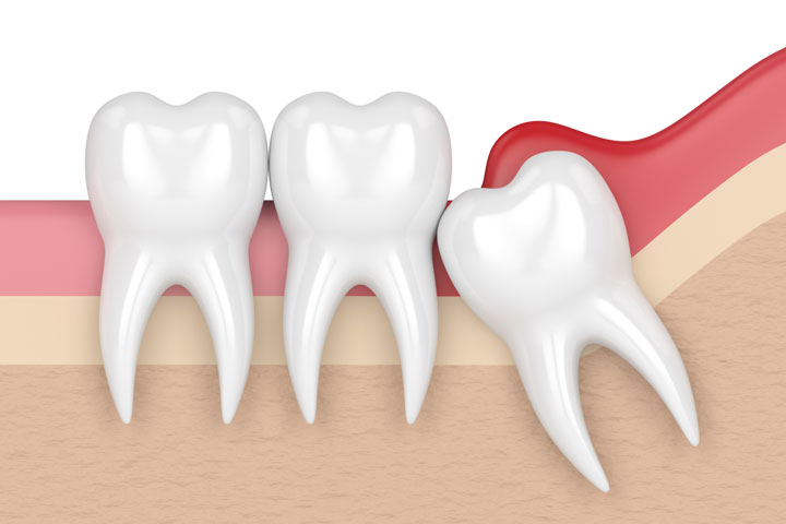 tooth-extraction-wisdom-tooth