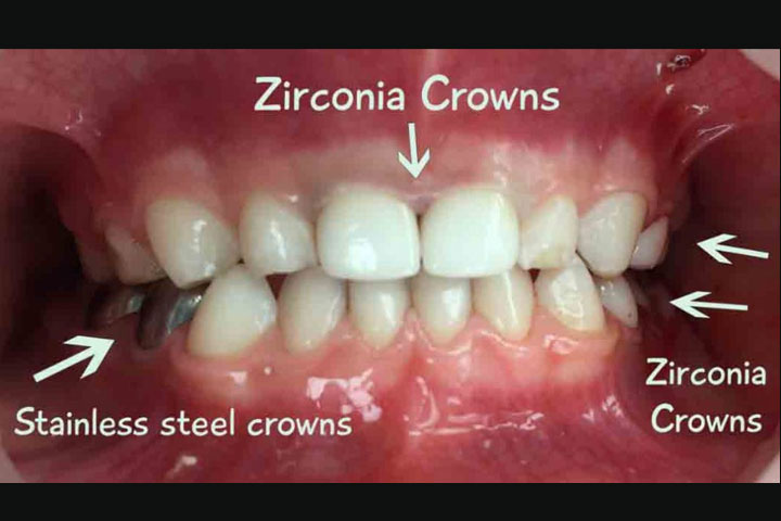 zirconia-crowns-dental-cure